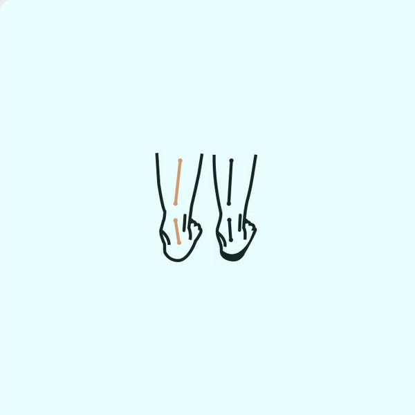Overpronation